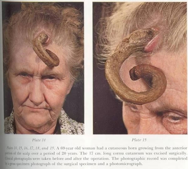 humans born with horns